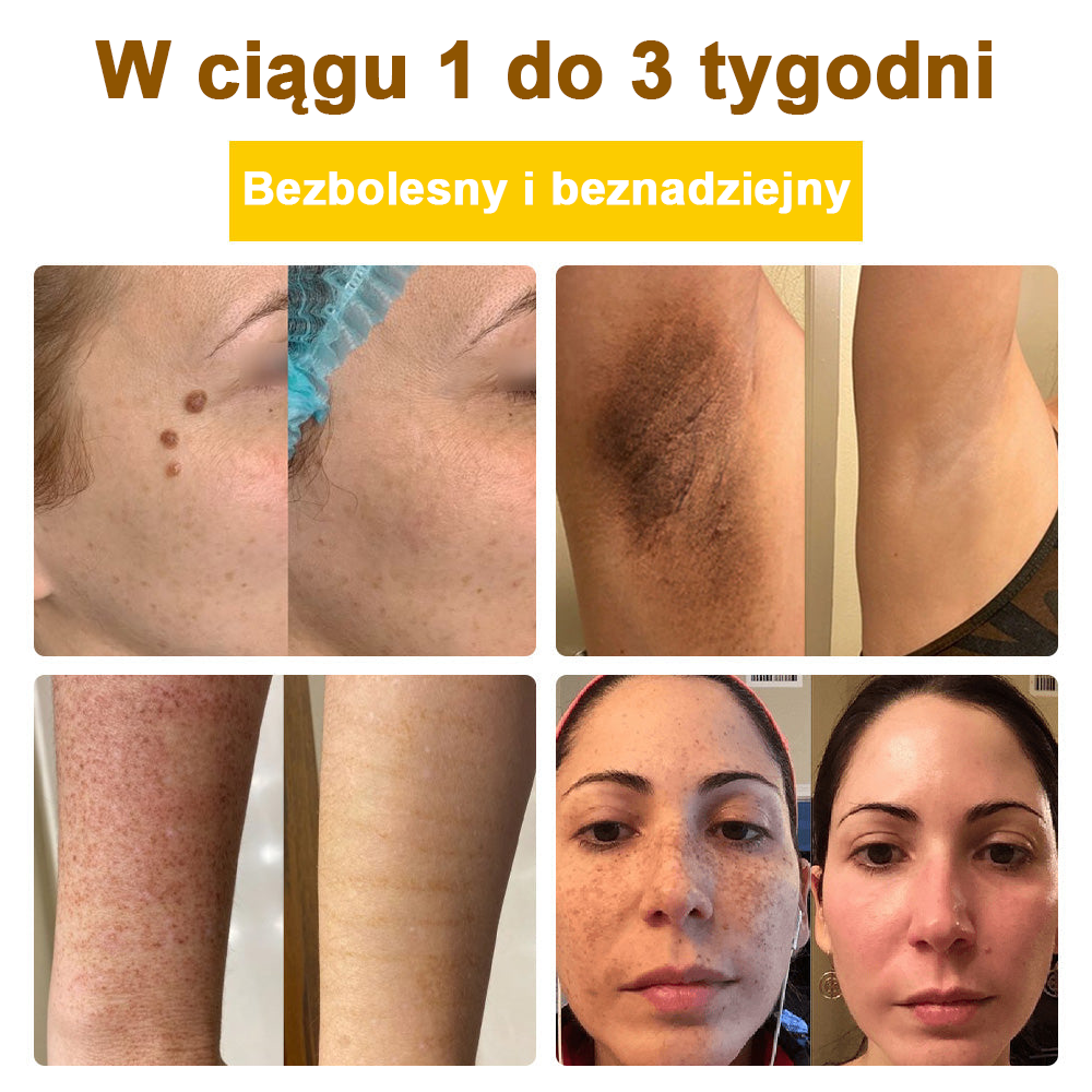 ✅flysmus™ Krem leczniczy z jadem pszczelim🐝: Leczenie egzemy, łuszczycy, trądziku, trądziku różowatego, infekcji grzybiczych, brodawek🐝