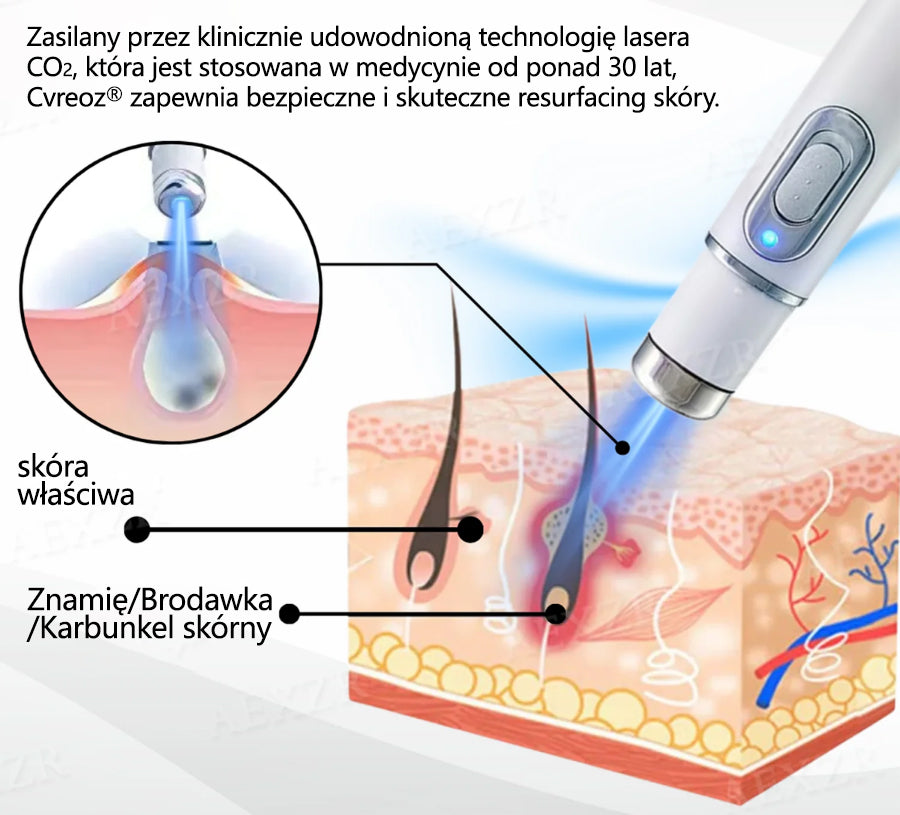Cvreoz® nowy nieinwazyjny laser do usuwania pieprzyków i brodawek 🎉🎉
