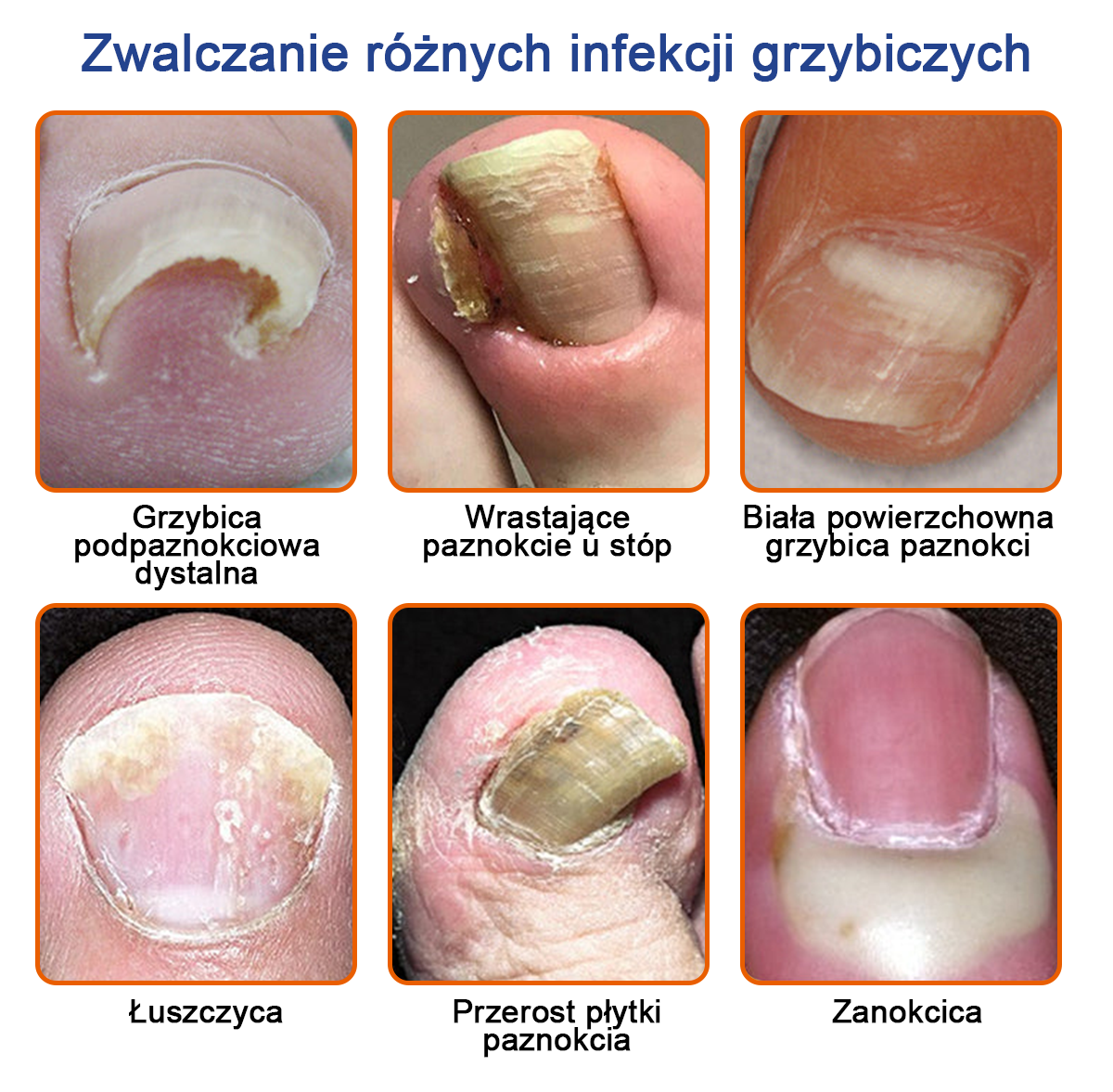 🐝👣Furzero™ Bienengift Nagelpilz Leczenie: Całkowite rozwiązanie problemu grzybicy paznokci🌟👣👣👣👣