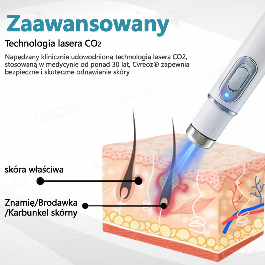 Cvreoz® nowy nieinwazyjny laser do usuwania pieprzyków i brodawek 🎉🎉