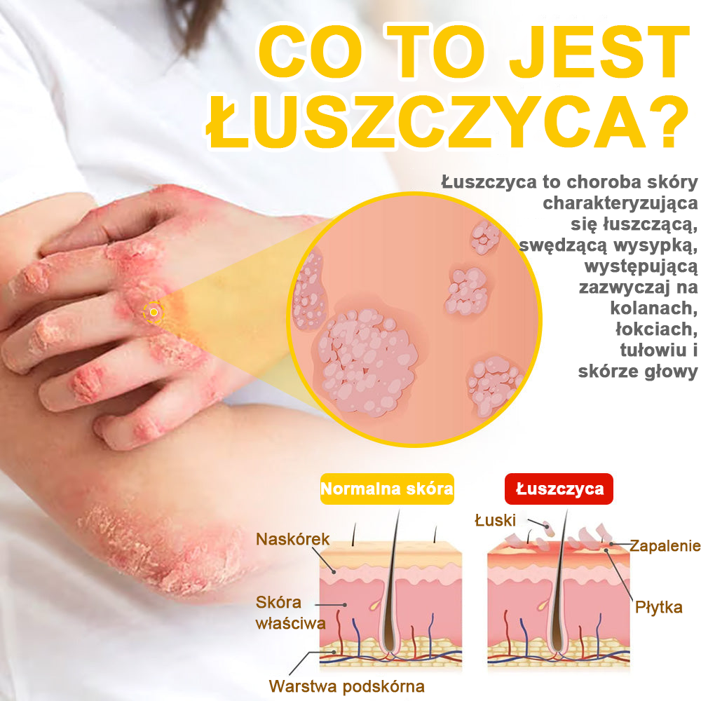 ✅flysmus™ Krem leczniczy z jadem pszczelim🐝: Leczenie egzemy, łuszczycy, trądziku, trądziku różowatego, infekcji grzybiczych, brodawek🐝