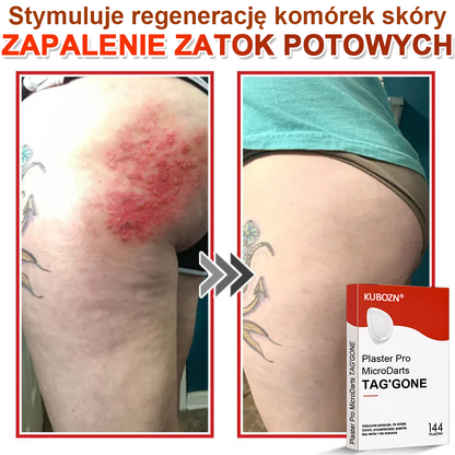 KUBOZN® Mikroigłowy Botaniczny Plaster na Usuwanie Brodawek Skórnych✨✨