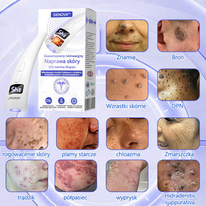 SIE𝖭𝖮𝖵𝖠™ Zaawansowany nieinwazyjny laser CO₂ do naprawy skóry 🎉 (Delikatnie usuwa brodawki, znamiona, plamy starcze i narośla skórne – bez bólu, bez zamieszania!)🔥