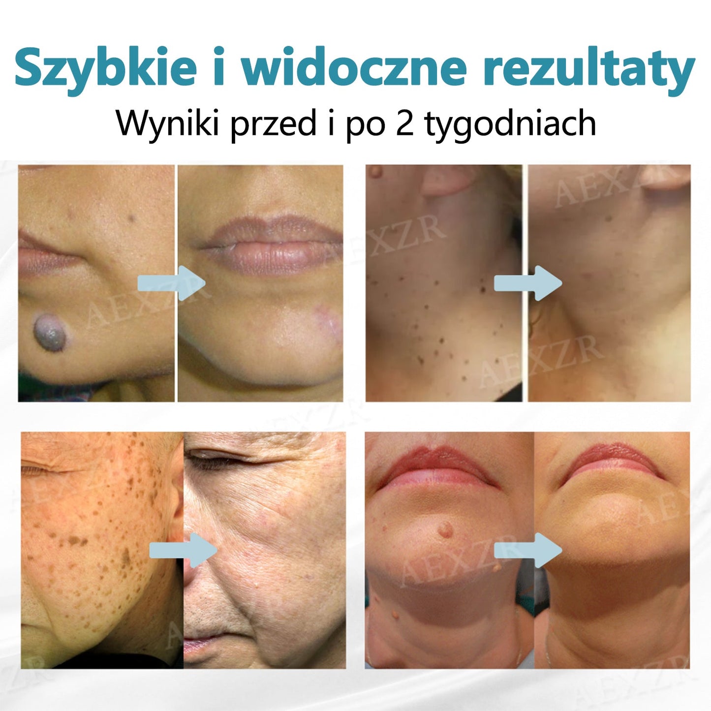 Cvreoz® nowy nieinwazyjny laser do usuwania pieprzyków i brodawek 🎉🎉🎉🎉