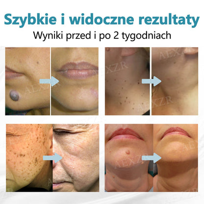 Cvreoz® nowy nieinwazyjny laser do usuwania pieprzyków i brodawek 🎉🎉🎉🎉