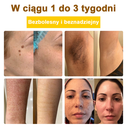 ✅flysmus™ Krem leczniczy z jadem pszczelim🐝: Leczenie egzemy, łuszczycy, trądziku, trądziku różowatego, infekcji grzybiczych, brodawek🐝