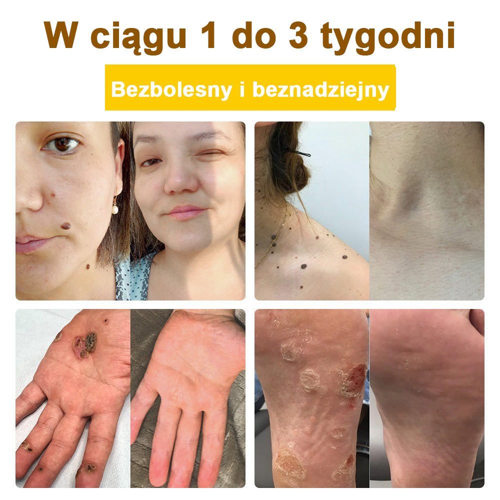 ✅flysmus™ Krem leczniczy z jadem pszczelim🐝: Leczenie egzemy, łuszczycy, trądziku, trądziku różowatego, infekcji grzybiczych, brodawek🐝
