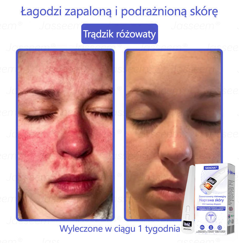 SIE𝖭𝖮𝖵𝖠™ Zaawansowany nieinwazyjny laser CO₂ do naprawy skóry 🎉 (Delikatnie usuwa brodawki, znamiona, plamy starcze i narośla skórne – bez bólu, bez zamieszania!)🔥