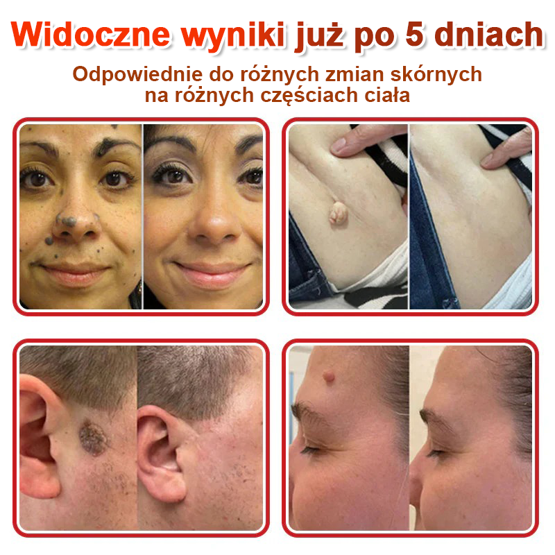 KUBOZN® Mikroigłowy Botaniczny Plaster na Usuwanie Brodawek Skórnych✨✨