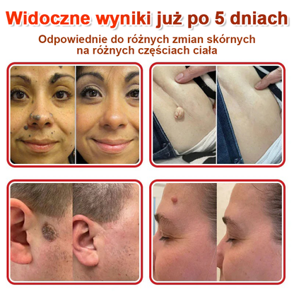 KUBOZN® Mikroigłowy Botaniczny Plaster na Usuwanie Brodawek Skórnych✨✨