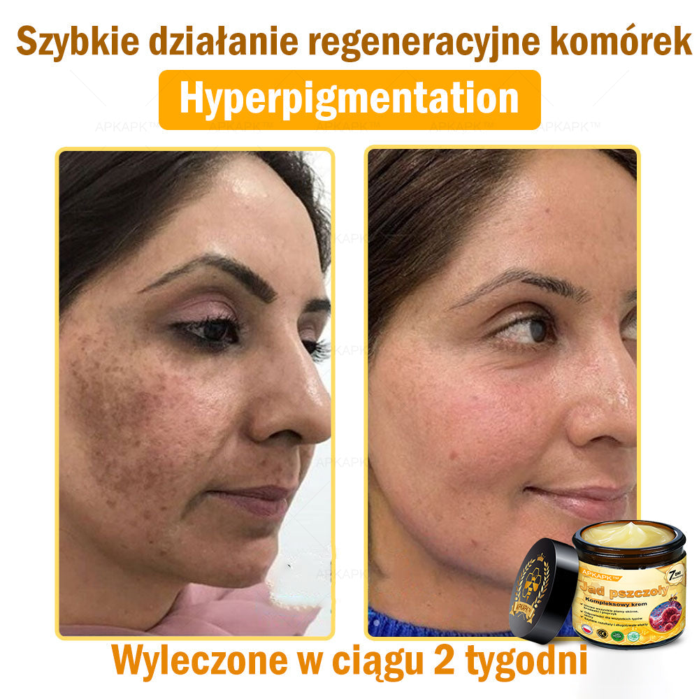 ΑPΚΑPK™ Jad Pszczoły Kompleksowy Krem🥇pomaga w leczeniu problemów skórnych, takich jak: zmarszczki, blizny, plamy pigmentacyjne, rozstępy, trądzik, łuszczyca, egzema, zmiany skórne, podrażnienia, stany zapalne i inne problemy skórne🔥🔥