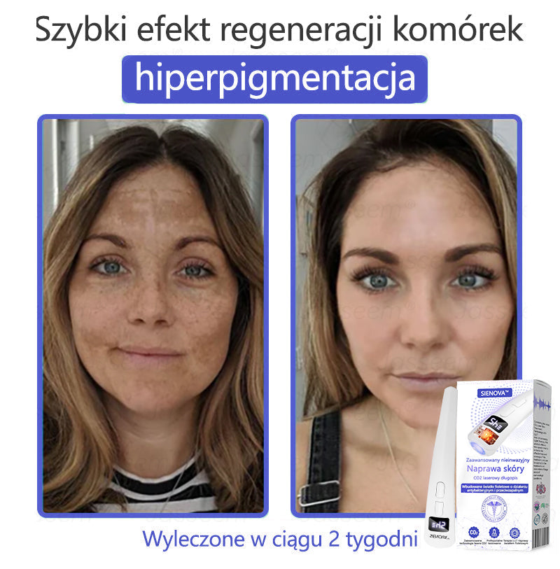SIE𝖭𝖮𝖵𝖠™ Zaawansowany nieinwazyjny laser CO₂ do naprawy skóry 🎉 (Delikatnie usuwa brodawki, znamiona, plamy starcze i narośla skórne – bez bólu, bez zamieszania!)🔥