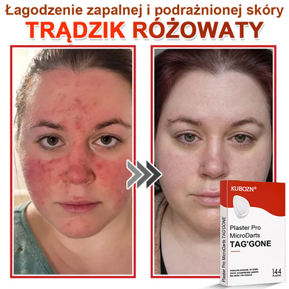 KUBOZN® Mikroigłowy Botaniczny Plaster na Usuwanie Brodawek Skórnych✨✨