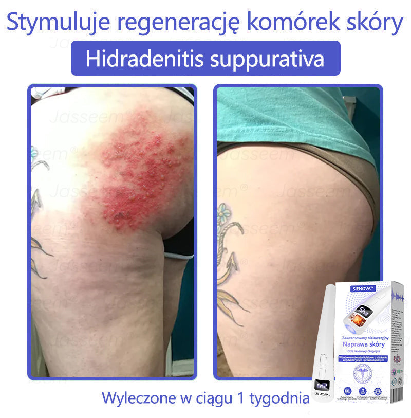 SIE𝖭𝖮𝖵𝖠™ Zaawansowany nieinwazyjny laser CO₂ do naprawy skóry 🎉 (Delikatnie usuwa brodawki, znamiona, plamy starcze i narośla skórne – bez bólu, bez zamieszania!)🔥