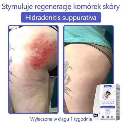 SIE𝖭𝖮𝖵𝖠™ Zaawansowany nieinwazyjny laser CO₂ do naprawy skóry 🎉 (Delikatnie usuwa brodawki, znamiona, plamy starcze i narośla skórne – bez bólu, bez zamieszania!)🔥