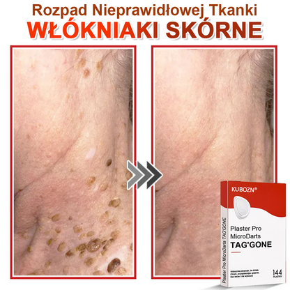 KUBOZN® Mikroigłowy Botaniczny Plaster na Usuwanie Brodawek Skórnych✨✨
