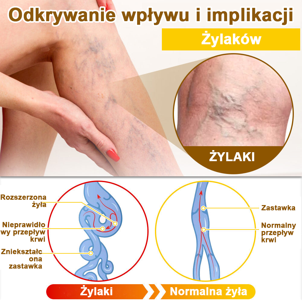 ✅flysmus™ Krem leczniczy z jadem pszczelim🐝: Leczenie egzemy, łuszczycy, trądziku, trądziku różowatego, infekcji grzybiczych, brodawek🐝