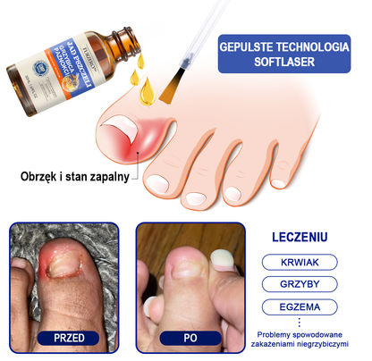 🐝👣Furzero™ Bienengift Nagelpilz Leczenie: Całkowite rozwiązanie problemu grzybicy paznokci🌟👣👣👣👣